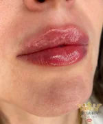 lip-queen-dr-ozge-aydin-dudak-dolgusu-ankara-003.webp